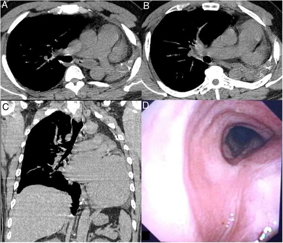 Pulmonary Agenesis | Archivos de Bronconeumología
