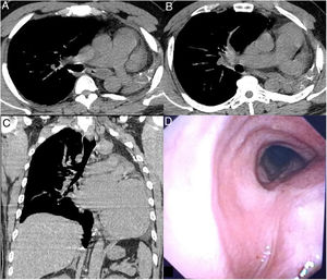 Agenesia pulmonary.
