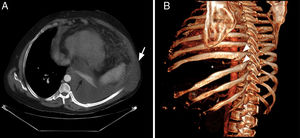A) Chest CT (axial view) showing herniation of left pleural effusion to the adjacent subcutaneous region (white arrow). Note complete atelectasis of the left lower lobe (black arrow). B) Three-dimensional CT reconstruction (left posterior oblique projection), showing fractures in the posteromedial region (arrowhead) of 2 contiguous ribs (8th and 9th) and significant widening of the eighth intercostal space (asterisk).