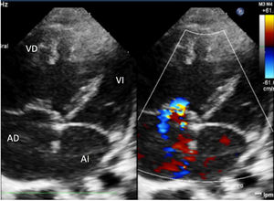 Echocardiography. 4-chamber view. Dilated right cavities with interventricular septum deviated to the left. Moderate tricuspid regurgitation with a gradient of 60 mmHg allowing estimation of a PAP of approximately 70 mmHg. Interatrial septum with 5 mm patent foramen ovale. Valves of normal morphology.