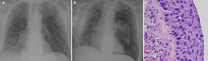 (A) Chest radiography showing right basal opacities and a diffuse interstitial bilateral pattern compatible with COVID-19. (B) Chest radiography showing q left complete pneumothorax and persistence of the radiological changes due to the COVID-19. (C) Microscopical detailed view of atypical cellularity with a high mitotic index (squamous cell carcinoma).