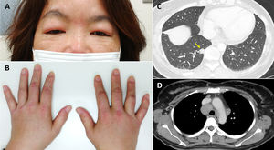 (A, B) Dermatological findings after the first examination of the patient. (A) Visible erythema over both eyelids (heliotrope rash) with facial edema. (B) Papules (Gottron
