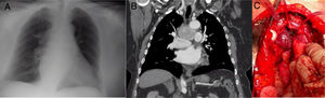 (a) Image of the mediastinal mass on chest X-ray. (b) Image of chest CT showing the mass in the middle mediastinum. (c) Paraganglioma during surgery, seen in the center of the image. The trachea is located at the top and the innominate vein is above it. The aorta is on the right and the pulmonary artery trunk below.