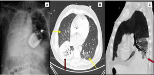 1A) Chest X-ray. Subtotal atelectasis of the right lung, ECMO ejection cannula in the right jugular and suction cannula in the inferior vena cava. Contrast computed tomography (arterial phase, lung window). 1B) Predominantly central ground glass infiltrates (yellow arrows) observed in both lung fields. Consolidation in right lower lobe (red arrow). 1C) Permeability of the bronchial tree observed in the center of the consolidation focus (For interpretation of the references to colour in this figure legend, the reader is referred to the web version of this article).