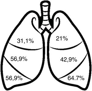 Distribution of bronchiectasis by lobes.