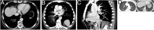 A) Axial chest CT image showing a tubular opacity in the posterior-basal segment of the right lower lobe corresponding to a large filling defect in the pulmonary vein of that segment (arrow). B and C) Oblique coronal (B) and sagittal (C) reconstructions of the chest CT (maximum intensity projection images) in which the continuity of the thrombosed vein (arrow) to the right inferior pulmonary vein (asterisk) and the left atrium (AI) can be best identified. D) Chest axial CT images (pulmonary parenchyma window at the aortic arch and bases) showing small bilateral parenchymal opacities (arrows).