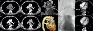 A) Non-contrast-enhanced phase of chest CT angiogram. Extensive mediastinal hematoma (*). B) Arterial phase of the study. Hypervascular nodular image within the subcarinal adenopathy, associated with right bronchial artery pseudoaneurysm. C-D) Early and late venous phases. No significant extravasation of contrast medium is observed to suggest active bleeding; note the vascular (arterial) nature of the lesion. E) Maximum intensity projection (MIP) in the oblique coronal plane. The nodular image (pseudoaneurysm, white arrow) can been seen to depend on the right bronchial artery (arrowhead). F) Volume-rendering. 3D reconstruction indicating the pseudoaneurysm (white arrow). G) Angiogram shows a contrast-filled nodular structure, with no extravasation in venous or parenchymal phases, consistent with pseudoaneurysm of the right inferior bronchial artery. H) Closure of the pseudoaneurysm after embolization. I-J) Mediastinal hematoma before (48.83mm) and after embolization (28.60mm).