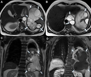 Axial T2-weighted MRI (A and B, respectively) show transdiaphragmatic lesion at the spleen level and multiloculated cystic lesion (arrows) with mediastinal extension at the level of esophageal hiatus. The presence of daughter vesicles in the cysts and the presence of relatively hypointense thick walls are typical features of the hydatid cyst. In the coronal T2-weighted (C) MR image, the cystic lesion (arrows) substantially fills the left hemithorax. The coronal image also reveals minimal pleural effusion. Postcontrast coronal T1-weighted (D) MR image reveals contrast enhancement (arrows) at the lesion