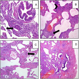A (case 19): Acute: peribronchiolar chronic inflammatory infiltrate with an interstitial giant cell (arrow); B (case 9): acute: interstitial chronic inflammatory infiltrate with a poorly formed granuloma (arrow) and peribronchiolar metaplasia (arrow-head); C (case 9): chronic HP: the same case, four years later: explant specimen showing airway-centered interstitial fibrosis with an interstitial giant cell (arrow); D (case 17): chronic HP: advanced fibrosis with microscopic honeycombing.
