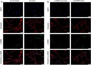 A and B: Representative examples of immunofluorescence staining of the markers DAPI (upper panel), vimentin (upper middle panel), alpha-SMA (lower middle panel), and CAFs (positively stained for both vimentin and alpha-SMA, bottom panel) in cultured fibroblasts obtained from non-tumor and tumor specimens of LC and LC-COPD patients. Definition of abbreviations: DAPI, 4’, 6-diamidino-2-phenylindole; alpha-SMA, alpha-smooth muscle actin; CAFs, cancer-associated fibroblasts; LC, lung cancer; COPD, chronic obstructive pulmonary disease.