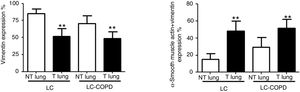 A and B: Mean values and standard deviations (SD) of levels of the markers vimentin and vimentin and alpha-SMA as measured by percentage of the total fibroblasts. Definition of abbreviations: alpha-SMA, alpha-smooth muscle actin; LC, lung cancer; COPD, chronic obstructive pulmonary disease. Statistical analyses: **, p ≤ 0.01 between tumor (T) and non-tumor (NT) lungs in both LC and LC-COPD patients.