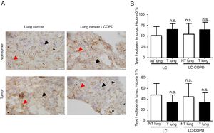 A) Representative examples of immunohistochemical staining for type I collagen in tumor and non-tumor specimens (collagen I-positively stained) in LC and LC-COPD patients, respectively. Black arrows point towards areas stained in blue with hematoxylin (negatively-stained for collagen), while red arrows point towards positively-stained areas (brown color). B) Mean and standard deviations (SD) of levels of type I collagen in tumor and non-tumor of both groups as measured using histoscores (see Methods). Definition of abbreviations: Hscore, histochemical score; LC, lung cancer; COPD, chronic obstructive pulmonary disease. Statistical analyses: n.s., no significance between tumor (T) and non-tumor (NT) lungs in either LC or LC-COPD patients.