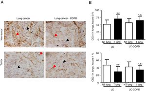 A) Representative examples of immunohistochemical staining for CD31 in tumor and non-tumor specimens (CD31-positively stained) in LC and LC-COPD patients, respectively. Black arrows point towards areas stained in blue with hematoxylin (negatively-stained for CD31), while red arrows point towards positively-stained areas (brown color). B) Mean and standard deviations (SD) of levels of CD31 in tumor and non-tumor of both groups as measured using specific histoscores (see Methods). Definition of abbreviations: Hscore, histochemical score; LC, lung cancer; COPD, chronic obstructive pulmonary disease. Statistical analyses: **, p ≤ 0.01 between tumor (T) and non-tumor (NT) lungs in LC patients; n.s., no significance between tumor (T) and non-tumor (NT) lungs in LC-COPD patients.