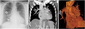 A) Chest X-ray (posteroanterior projection) showing an enlarged right atrium (arrowhead) and an increase in the size and density of both hili (curved arrows); note the presence of a tubular structure in the right lung (straight arrows). B and C) Coronal reconstruction MIP (maximum intensity projection) (B) and 3D (C) images confirming the existence of drainage from the right upper lobe vein to the superior vena cava (straight arrows). Furthermore, the venous return of the middle lobe and several segments of the right lower lobe also drained into this tubular structure. Signs of precapillary pulmonary hypertension with increased pulmonary artery trunk width (asterisk) and secondary RA enlargement are seen. RA: right atrium; Inn: innominate vein; SCV: superior vena cava; RV: right ventricle.