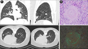 Amyloidosis.