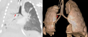 Computed tomographic and three-dimensional reconstruction of computed tomographic images showing the trifurcation with an ectopic right upper lobe bronchus (red arrow).
