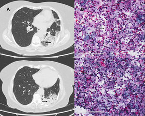 (A) Computed tomography. Areas of airspace consolidation and ground glass opacities in left hemitorax. (B) Bronchoalveolar lavage cytology. Abundant macrophages with foamy vacuolated cytoplasm.