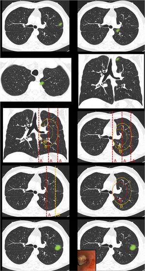 This block evaluated the uniformity of criteria defining centrality. Image 1: In your opinion, is the site of the nodule: central/peripheral? Image 2: In your opinion, is the site of the nodule: central/peripheral? Images 3a and 3b: In your opinion, is the site of the nodule: central/peripheral? Image 4: Which of the following lines best defines centrality? A lines/B lines. Image 5: Which of the following lines best defines centrality? A lines/B lines. Image 6: Which of the two lines demarcates a central tumor? A line (inner third)/B line (inner two thirds). Image 7: Which of the two lines demarcates a central tumor? A line (inner third)/B line (inner two thirds). Image 8: In your opinion, is the site of the nodule: central/peripheral? Image 9: In your opinion, is the site of the nodule: central/peripheral?