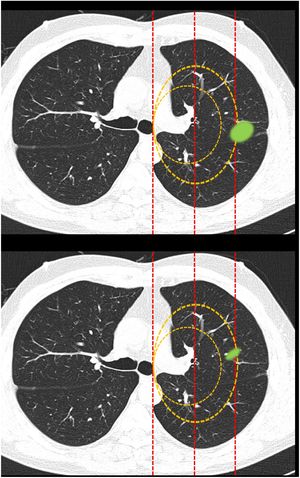 This block evaluated the uniformity of criteria used to classify a lesion as central in lesions that extend beyond the dividing lines. Image 10: If a tumor located in the inner two thirds of the hemitorax is defined central, in your opinion, is the site of the nodule: central/peripheral? Image 11: If a tumor located in the inner two thirds of the hemitorax is defined as central, in your opinion, is the site of the nodule: central/peripheral?
