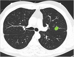This block evaluated respondents’ ability to properly classify a central lesion in the absence of dividing lines. Image 12: If a tumor located in the inner two thirds of the hemitorax is defined as central, in your opinion, is the site of the nodule: central/peripheral?