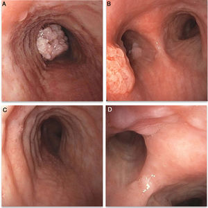A (left main bronchus) and B (distal trachea): endobronchial papillomatous lesion as seen before debulking; C and D: final result 18 months after initial presentation and first debulking.