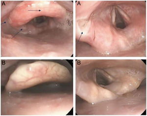 A. Ulcers (arrows) seen on flexible bronchoscopy. B. Lesions practically resolved in follow-up bronchoscopy.