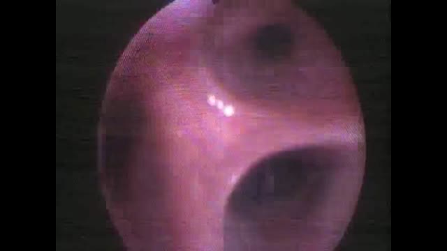 https://ars.els-cdn.com/content/image/1-s2.0-S1579212921001555-mmc1.mp4