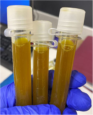 Dark green “Bilothorax” pleural fluid.