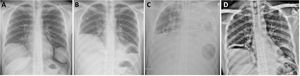 Chest X-ray at diagnosis showing 2 uncomplicated cystic lesions (A); following rupture of the left lung hydatid cyst (B); air-fluid level after placement of ECMO, showing opacification of the entire left hemithorax and air in the left lung base (C); and after withdrawal of ventilatory support and ECMO (D).