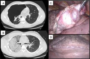 (A and B) CT showing complete pneumothorax and unilateral ground glass pattern. (C and D) Intraoperative findings: blebs.