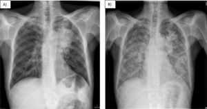 Radiological progress throughout hospital admission. Chest X-ray on admission (A) revealing a lung mass measuring 10cm×5cm causing atelectasis of the left upper lobe, along with apical fibrosis and calcified granulomas. Chest X-ray 14 days after admission (B) revealing bilateral diffuse micronodular interstitial infiltrate not present on the previous X-ray.