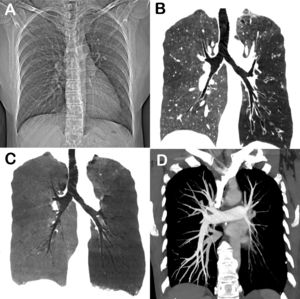 (A) CT scout image in inspiration showing reduced lung volume on the left side, with homolateral displacement of the mediastinum. Chest CT coronal reconstructions with maximum-intensity (B) and minimum-intensity (C) projections demonstrate diffuse decreased density of the left lung, with bronchiectasis in the lower lobe. (D) Angio-CT image showing hypoplasia of the left pulmonary artery and its branches.