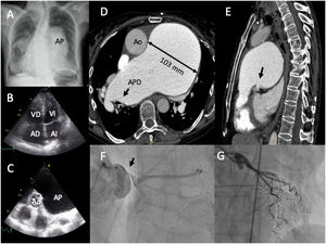 A: chest X-ray, posteroanterior projection. B: transthoracic echocardiography, apical 4 chamber view. C: transthoracic echocardiography, short axis parasternal plane at the level of the large vessels. D–E: chest computed tomography with contrast medium, mediastinal window. F–G: coronary angiography, anteroposterior projection. AP: pulmonary artery; VD: right ventricle; VI: left ventricle; AD: right atrium; AI: left atrium; Ao: Aorta; APD: right pulmonary artery.