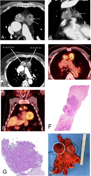 A) and B) Axial (A) and coronal (B) chest CT images showing two masses in the anterior mediastinum: a right mass (white asterisk) and a left mass (black asterisk). Note the presence of calcification foci in the left mass (arrows). C) Axial CT image of the chest clearly showing the different attenuation characteristics of the mediastinal masses: the right mass (white asterisk) has a mean attenuation of 83 Hounsfield units while the left mass (black asterisk) has a mean attenuation of 54 Hounsfield units, suggesting an independent origin. D) and E) Axial (D) and coronal (E) PET/CT images showing the different metabolic activity of the two mediastinal masses (greater FDG uptake by the left mass [6.1, black asterisk] than by the right mass [3.6, white asterisk]), suggesting two independent tumors. F) Percutaneous biopsy sample of the left mediastinal mass showing neoplastic proliferation of epithelial cells surrounded by fibrous tissue and scant lymphocytes, associated with type B3 thymoma (hematoxylin and eosin). G) Percutaneous biopsy sample of the right mediastinal mass in which a mainly lymphocyte component is identified with some prominent epithelial cell nests, associated with type B2 thymoma. H) Post-surgical macroscopic piece showing both contiguous masses (white circle: right mass; black circle: left mass). CT: computed tomography; FDG: fluorodeoxyglucose; PET/CT: positron emission tomography.