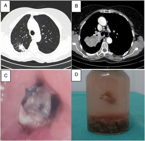 (A and B) Computerized tomography (CT) of the chest showed a nodular image with a diameter of 24mm and atelectasis of the posterior segment of the right upper lobe; (C) flexible bronchoscopy revealed total obstruction of the posterior segment of the right upper lobe by amorphous material with abundant granulation tissue; (D) macroscopic appearance of the aspirated material was compatible with rice grains.