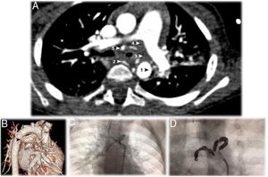 A – Thoracic computed tomography angiography (CTA), in axial plane, showing the anomalous artery, originating in the right side of the descending thoracic aorta (AoD), encircling the left main bronchus at the point of bronchial stenosis. The anomalous bronchial artery originates two bronchial arteries, right and left. The five arrows point to 1: the origin at the aorta; 2: the first branch, which is a normal right intercostobronchial branch; 3: the second branch, which is an aberrant bronchial trunk; 4 and 5: the two vessels originate from the bronchial trunk to form right and left bronchial arteries. B – Computerized tomography reconstruction arteriography view showing the tortuosity of the anomalous bronchial artery described in a (). C – Dynamic image showing the anomalous bronchial artery tortuous path around the left main bronchus. D – Endovascular embolization of the abnormal vessel, occluded with 12 microcoils.