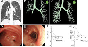 Coronal chest CT image (A) and three-dimensional chest CT image (B) acquired before the operation and three-dimensional chest CT image acquired 3 months after the operation (C). Flexible fiber-optic bronchoscopic images before the operation (D) and 3 months after the operation (E). Flow-volume loops before the operation (F) and 3 months after the operation (G).