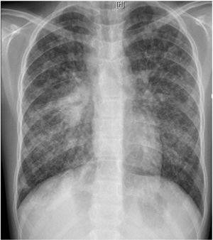 Chest X-ray: diffuse alveolo-interstitial opacities, with right parahilar consolidation with central cavitation.