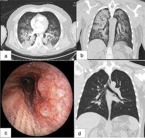 (a, b) Axial and coronal views of thoracic computed tomography performed after admission in intensive care unit; (c) lesion observed in bronchoscopy on day five after admission. (d) Coronal view of thoracic computed tomography performed 15 days after the first tomographic evaluation.