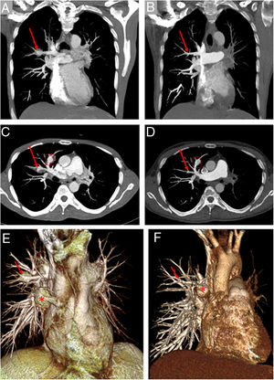 In presentation, coronal (A) and axial (C) MIP thorax CT angiography scans reveal aneurysms in the anterior (frame) and posterior (arrow) segmentary pulmonary arteries of the right upper lobe. In control examination eight months after corticosteroid and intravenous cyclophosphamide treatment, coronal (B) and axial (D) MIP thorax CT angiography scans show complete resolution (arrow) of the aneurysm in the posterior segmentary pulmonary artery of the right upper lobe. Aneurysm (frame) in the anterior segmentary pulmonary artery shows persistently in CT angiographic images. In presentation (E) and control examination (F), anterior view 3D volume rendering CT images reveal clearly persistent (asterisk) and shrinking (arrow) aneurysms.