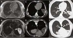 A–F) Migrating pleuropericardial cyst: A) MRI T1-enhanced axial image showing hypointense lesion (asterisk) in the left fissure. B) MRI T2-enhanced axial image showing hyperintense lesion (asterisk) in left fissure extending to pericardium (arrow). C) CT axial image obtained in supine position revealing a lesion of fluid density (asterisk). D) CT axial image obtained in prone position showing a lesion of fluid density (asterisk) with anterior shift compared to in the supine position. E) CT axial image obtained in supine position in lung window showing lesion (asterisk) in.