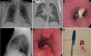Posteroanterior and lateral chest X-ray with no changes. A) CT reconstruction of the chest showing the pull tab in the intermediate bronchus (arrow) in a coronal slice. B) Proximal tip of the pull tab embedded in the distal third of the intermediate bronchus. C) Endoscopic view after removal of the pull tab, showing persistent proximal and distal granulation tissue forming a septum. D) Pull tab.