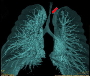 Narrowing of the tracheal lumen where it meets the brachiocephalic artery, affecting mainly the anteroposterior axis, which is reduced to 1.3 mm, with a laterolateral axis of 3.3 mm.