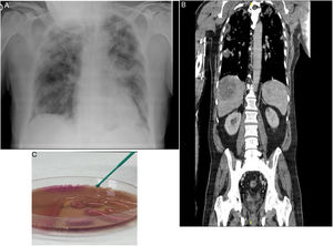A: Chest X-ray on admission: bilateral pulmonary infiltrates compatible with bronchopneumonia. B: Thoracoabdominal CT scan, coronal slice, showing liver abscess and bilateral pulmonary infiltrates. C: MacConkey agar plate: growth of hypermucoviscous Klebsiella pneumoniae colonies.