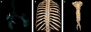 (A) Coronal anterior projection air specific volume rendering 3D CT image shows a normal right upper lobe bronchus (arrow) and narrowed lower lobe bronchus (dashed arrow), but there is not middle lobe bronchus. (B) Posterior view 3D volume rendered CT image reveals fusion anomalies (frames) in multiple segment between fifth and sixth ribs. (C) Anterior view 3D volume rendered CT image shows a giant forked shaped xiphoid of the sternum.