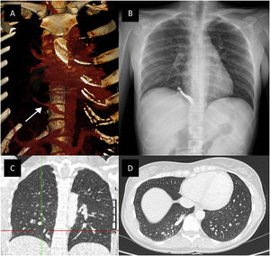 (A) Reconstruction of thoracic CT. Anomalous systemic artery arising from the abdominal aorta (white arrow). (B) 3-Month-follow-up with chest X-ray show the coils in the anomalous artery in the RLL. (C and D) Anomalous systemic artery arising from the abdominal aorta supplying a normal lung parenchyma.