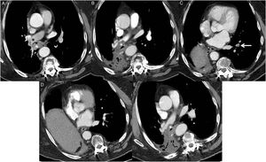 Chest CT images following administration of intravenous contrast, axial plane and mediastinal window. A) Chest CT image obtained 2 years after thoracic surgery (right inferior lobectomy) showing tumor recurrence (white asterisk) and patent intermediate pulmonary artery (black asterisk). B) Chest CT image obtained 12 months after radiation therapy, identifying an eccentric filling defect that forms obtuse angles in the right lower lobe artery stump with extension proximal to the intermediate artery (asterisk). C) Chest CT image obtained 18 months after image B, showing a central filling defect in a segmental artery in the left lower lobe (arrow), consistent with acute PE. D and E) Chest CT images obtained 6 months after image C, which showed resolved PE but persistent pulmonary artery stump thrombosis (asterisk).