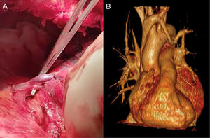 A. Partial anomalous pulmonary venous return (PAPVR) straddling the left main pulmonary artery. B. Volumetric reconstruction of left pulmonary vessels showing the PAPVR draining into the left brachiocephalic trunk.