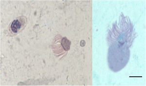 Cytological sputum smear. Left: Ciliocytophthoria phenomenon, and an accompanying polymorphonuclear leukocyte (Papanicolaou, 1000×). Right: Lophomonas blattarum. Bar scale 20 μm (Wheatley trichrome stain, 1000×).