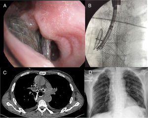 A) Flexible bronchoscopy view showing a continuity defect in the posterior wall of the distal third of the trachea, with visualization of esophageal stents and atrial septal defect occluder. B) Fluoroscopic view of the 3 normally positioned stents by flexible bronchoscopy through rigid bronchoscope. C) Chest CT image without intravenous contrast, axial plane, lung window showing the presence of the 3 devices used for closing the fistula. D) Plain post-anterior chest X-ray after intervention showing correct positioning of the 3 implanted devices.